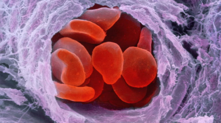 En introduktion till hemofili